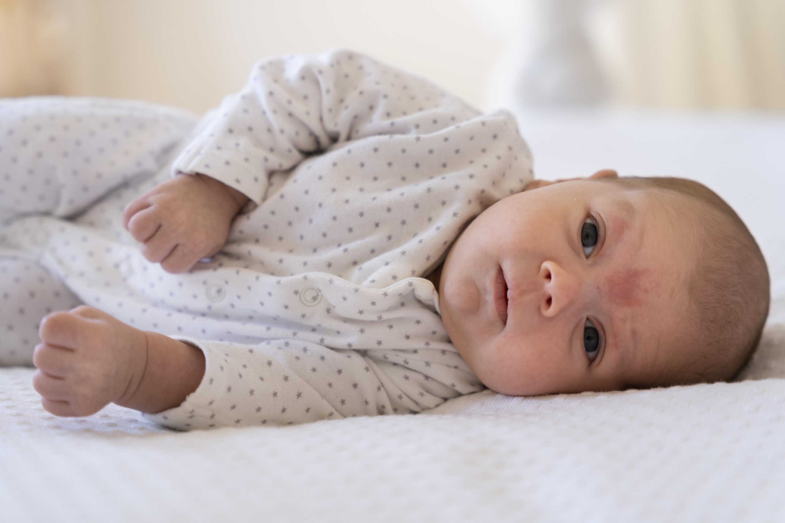 baby acne