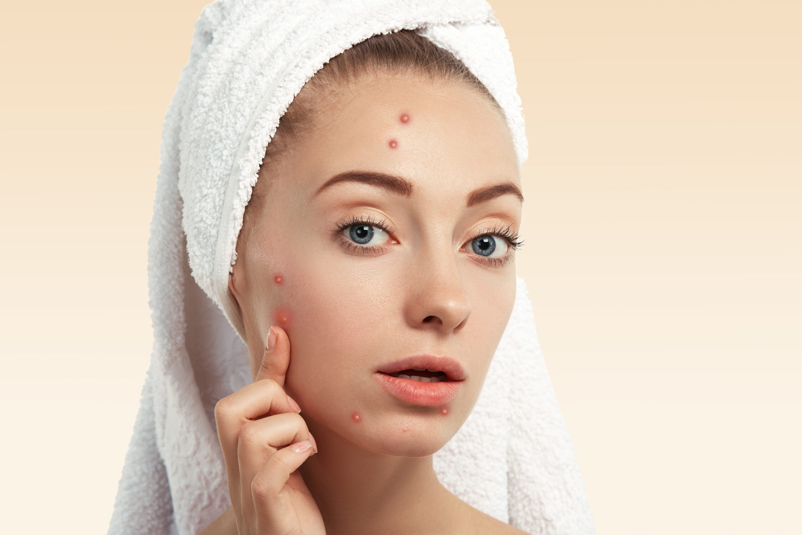 what causes acne