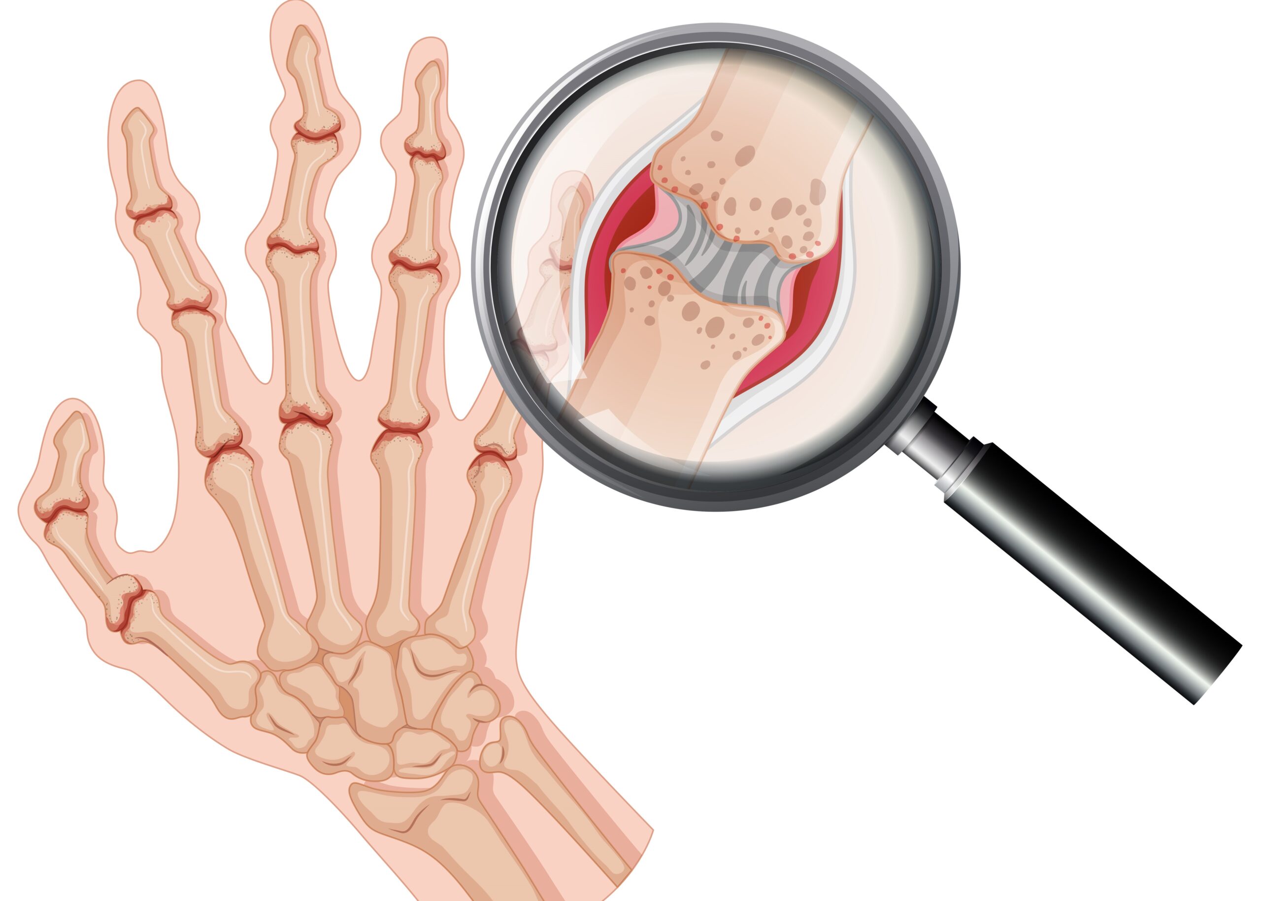types of rheumatoid arthritis