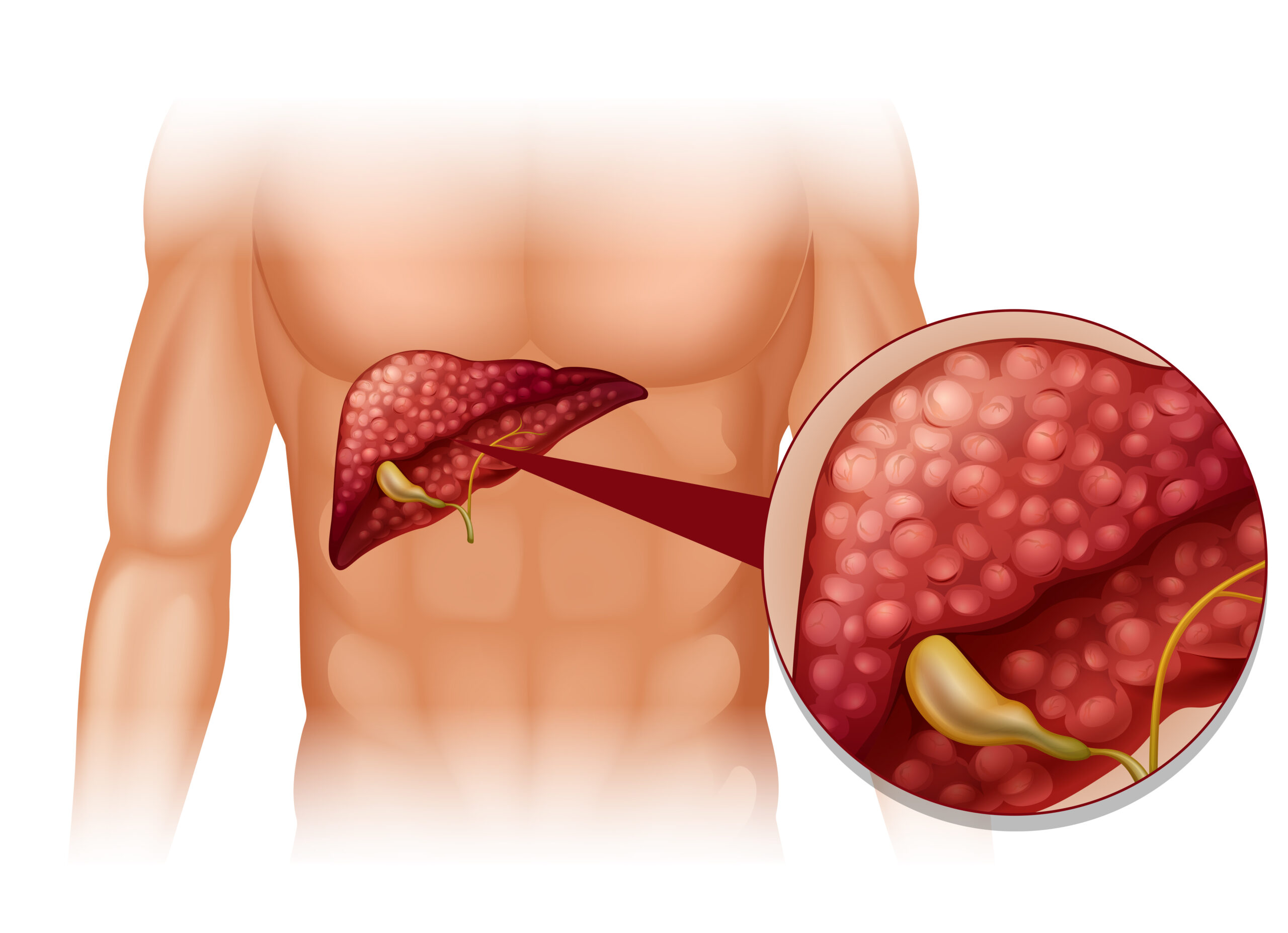 how many grades of fatty liver