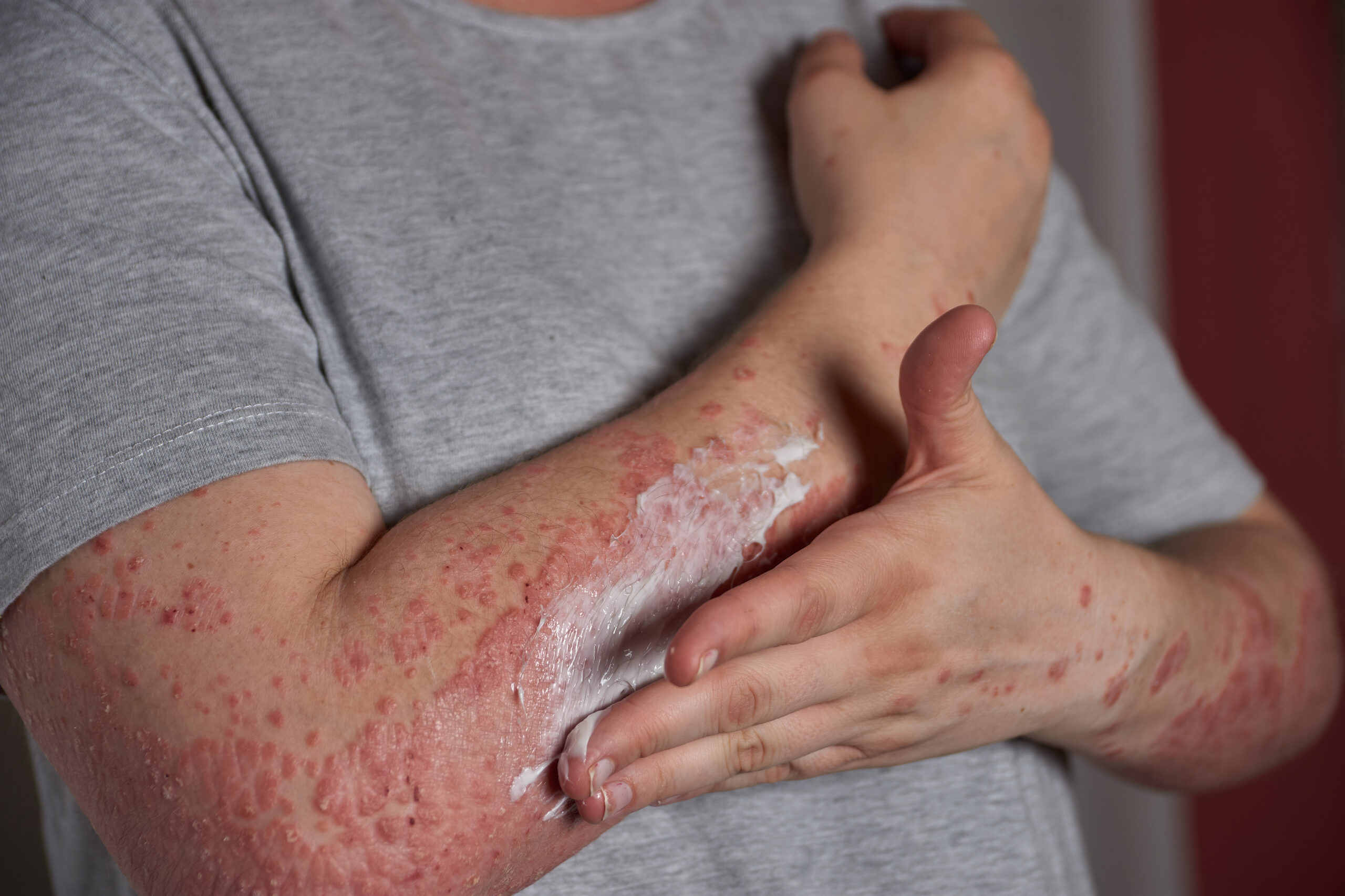 lupus vulgaris