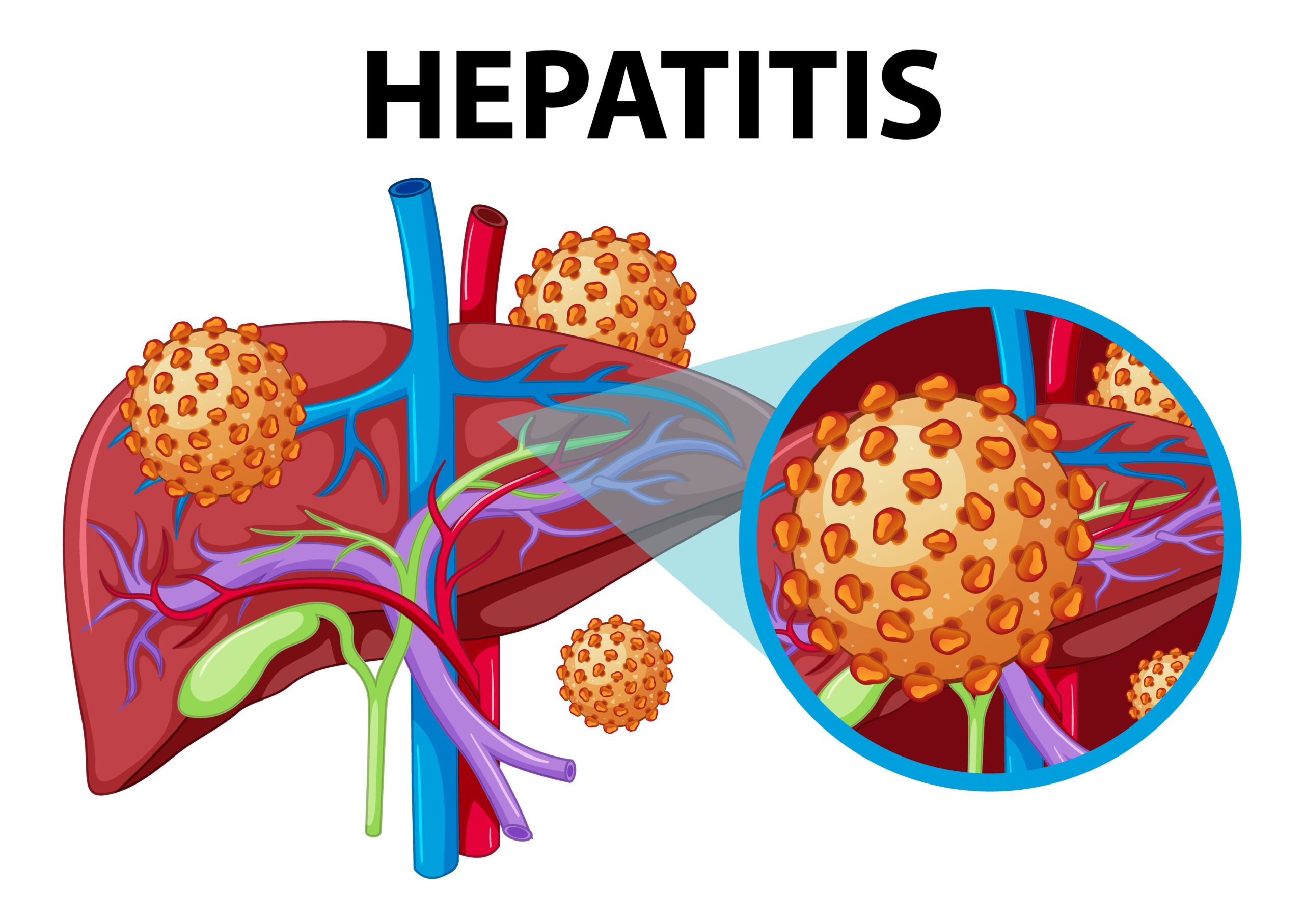 autoimmune hepatitis symptoms