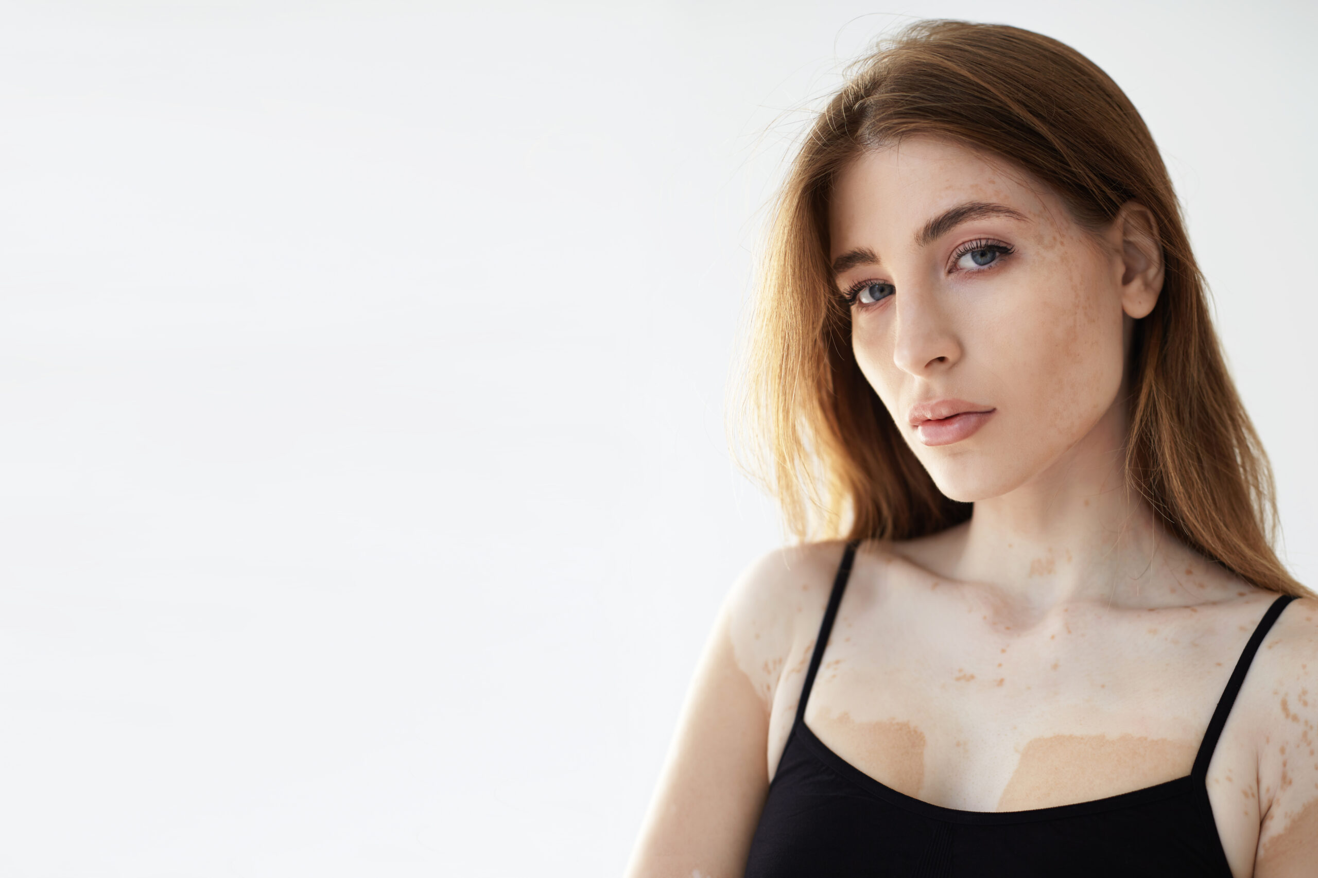 vitiligo early symptoms